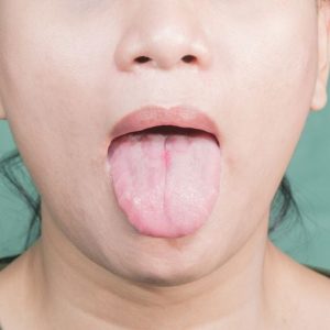 Cos’è la sindrome della bocca che brucia? Segni e sintomi