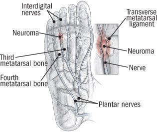Neuroma di Morton