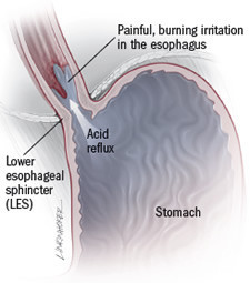 Malattia da reflusso gastroesofageo (GERD) 3