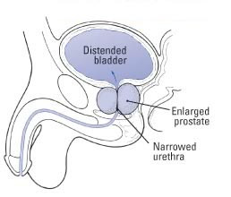 Prostata ingrossata (iperplasia prostatica benigna) 1