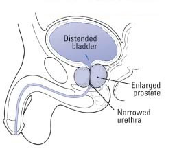 Prostata ingrossata (iperplasia prostatica benigna) Prostata ingrossata (iperplasia prostatica benigna)
