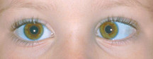 Occhio pigro (ambliopia) 1