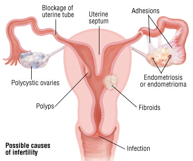 Infertilità femminile Infertilità femminile