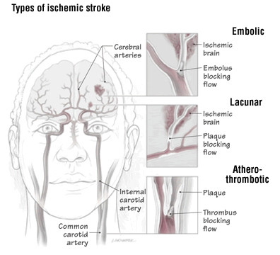Ictus lacunare Ictus lacunare