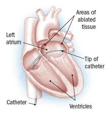 Aritmie cardiache 4 Aritmie cardiache 3