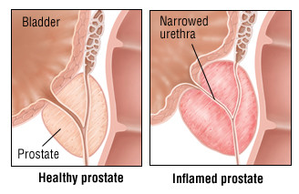 Prostatite cronica 4 Prostatite cronica 3