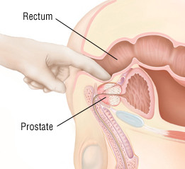 Prostatite cronica 5