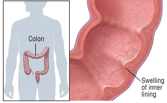 Colite ulcerosa 1