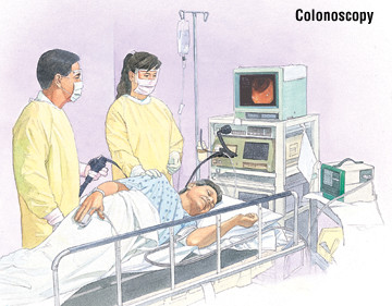 Colite ulcerosa 3