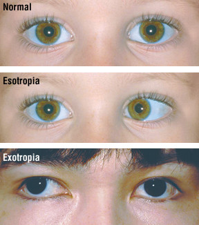 Occhi incrociati (strabismo) 1