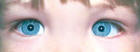 Occhi incrociati (strabismo) 3