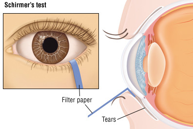 Sindrome dell’occhio secco