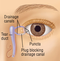 Sindrome dell'occhio secco 3