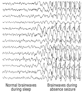 Elettroencefalogramma (EEG)