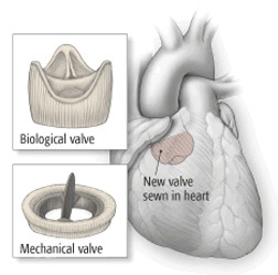 Problemi alle valvole cardiache