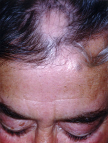Alopecia areata 1