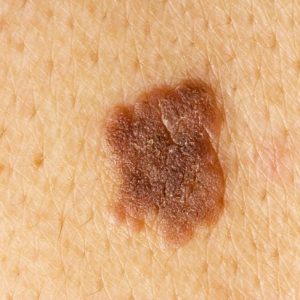 10 sintomi del sarcoma di Kaposi 10 sintomi del sarcoma di Kaposi