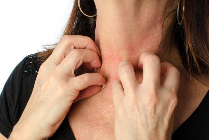 10 cause e fattori scatenanti dell'eczema 5