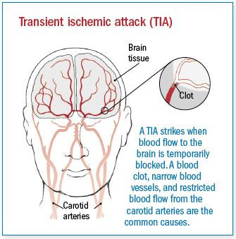 Attacco ischemico transitorio (TIA)