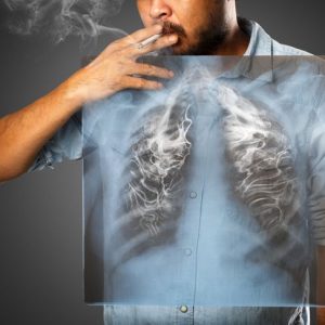 10 Cause, sintomi e trattamenti: Pneumotorace 10 Cause, sintomi e trattamenti: Pneumotorace