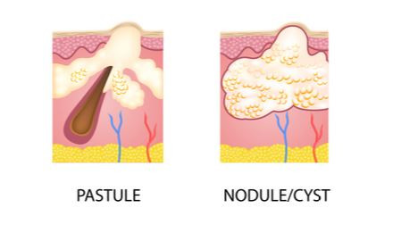 Acne 6 Acne 5
