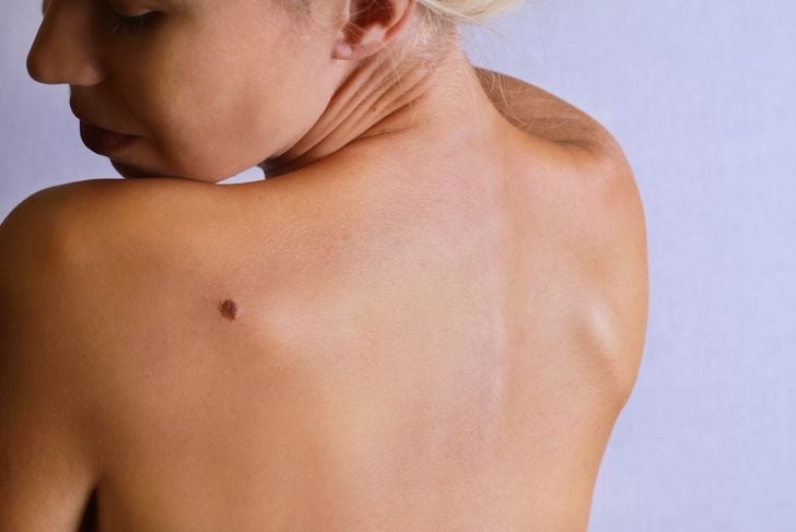 10 sintomi del melanoma 1