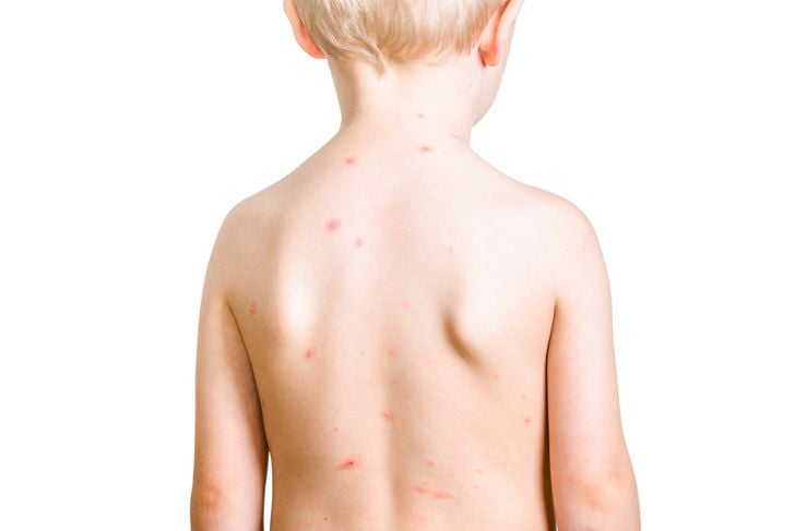 10 sintomi della varicella 3