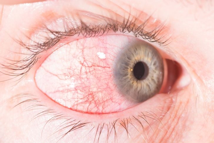 13 cause di occhi rossi 25
