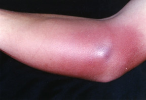 Infezione cutanea da MRSA Infezione cutanea da MRSA