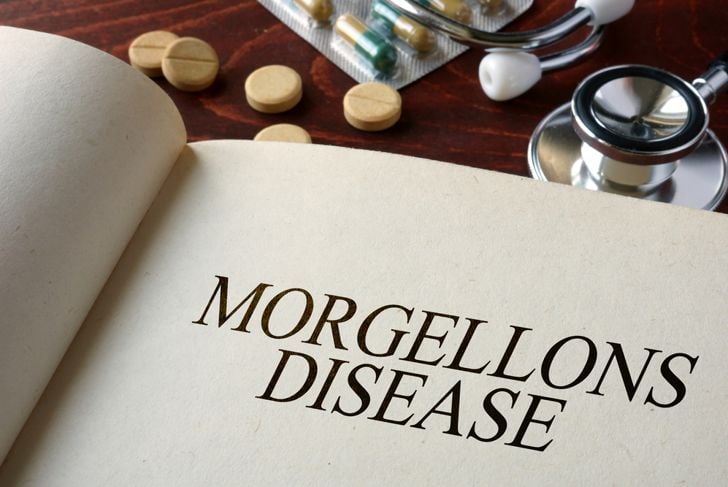 Domande frequenti sulla malattia di Morgellons 13