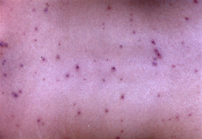 Varicella