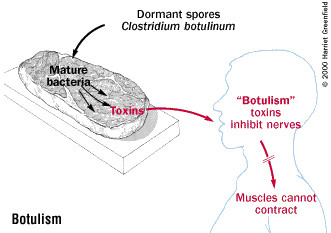 Botulismo