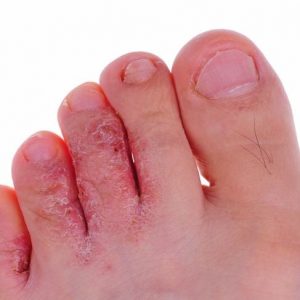 10 problemi comuni dei piedi