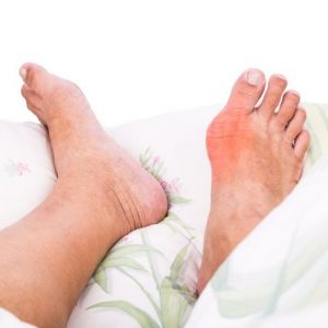 10 sintomi dell’artrite reumatoide