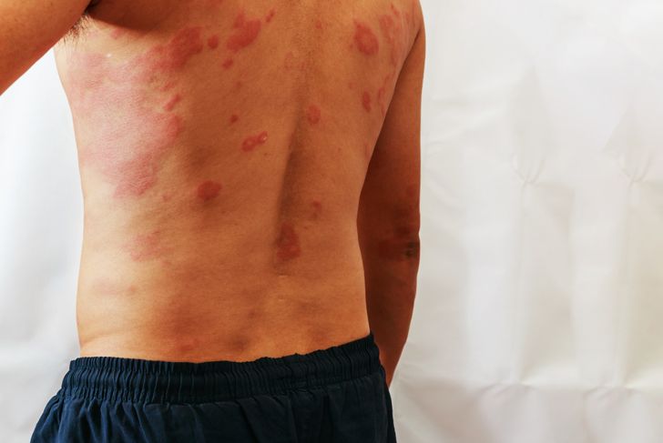 10 sintomi della chikungunya 11