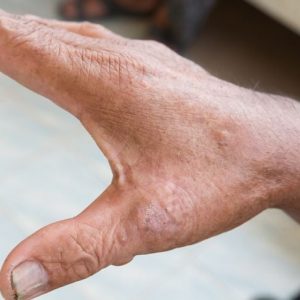 10 importanti sintomi della sclerodermia