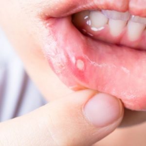 10 sintomi del cancro alla bocca