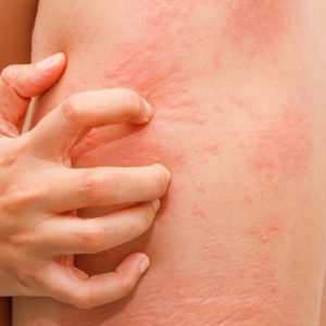 10 sintomi di allergia ai sulfamidici