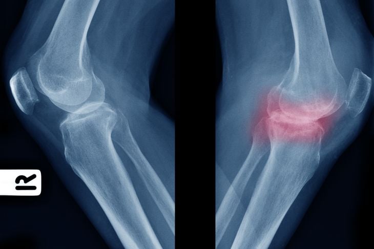 10 sintomi di dolore al ginocchio 15