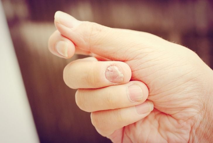 10 cose inquietanti che le unghie rivelano sulla vostra salute 15