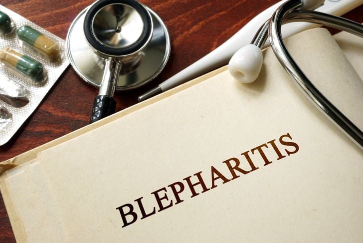 Cause e sintomi della blefarite 11