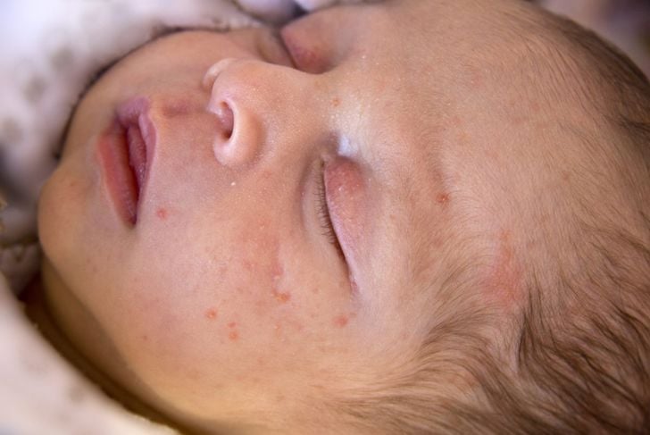 Un'eruzione cutanea sul viso del bambino: Aspettare o preoccuparsi? 5