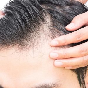 10 trattamenti per la caduta dei capelli