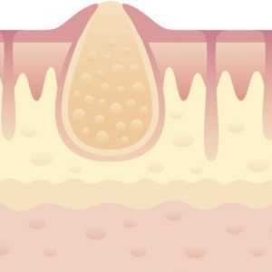 10 sintomi di MRSA 10 sintomi di MRSA