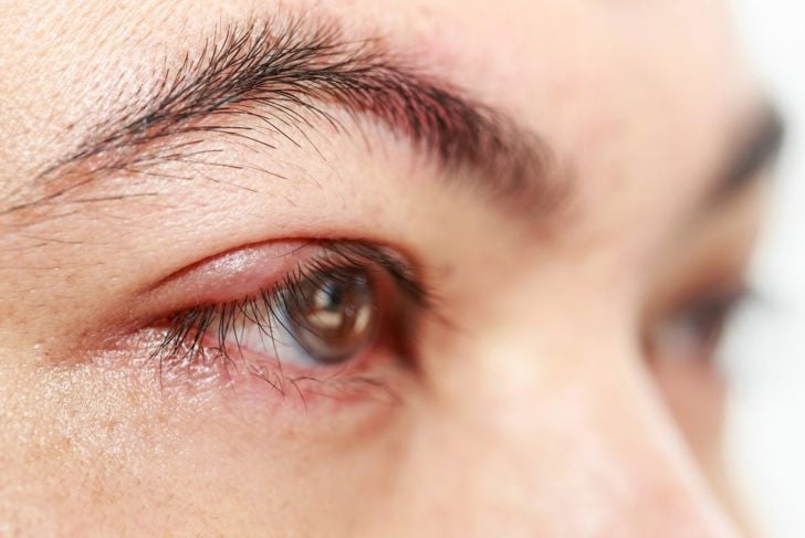 Cause e trattamenti della secrezione oculare 5