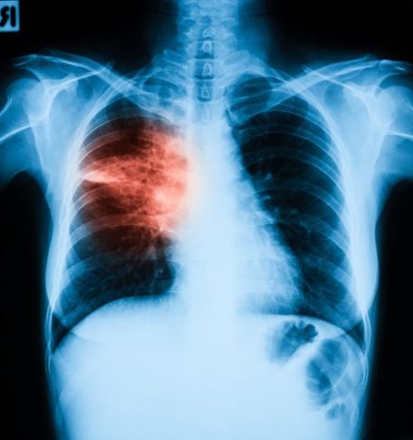 Che cos'è la polmonite da aspirazione? 13
