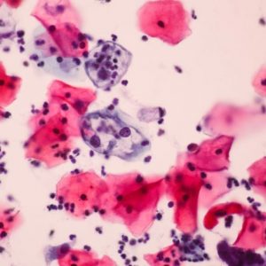 Cos’è la displasia cervicale? Sintomi e trattamenti