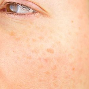 10 sintomi della neurofibromatosi