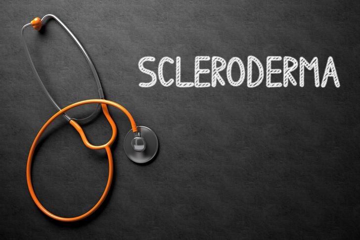 10 sintomi della sclerodermia 5