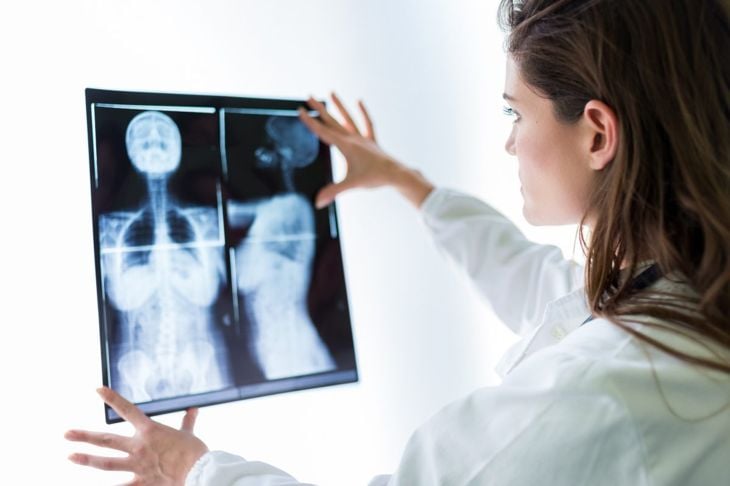 10 fatti importanti sull'osteomalacia 9